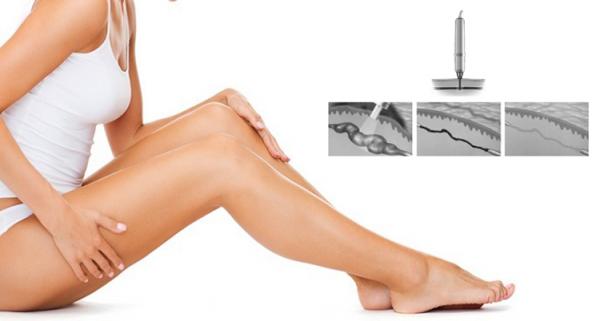 Medical CE approved 980nm laser diode spider vein laser removal for facial and legs