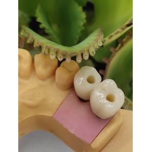 China Cemented Solution NOBEL BIOCARE Dental Implants Crown on sale