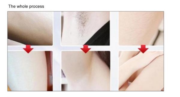 OEM Acne Treatment Skin Rejuvenation Ipl Shr Hair Removal Machine