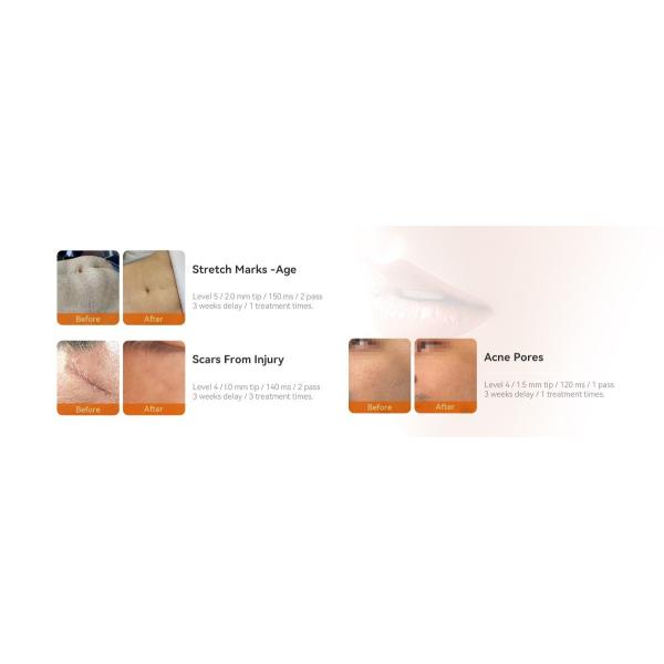 Protable Fractional Micro Needle Vacuum RF Machine RF Vacuum Lifting Microneedling Machine