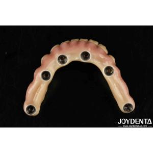 Quality Durable Dental Aesthetic Titanium Malong Hybrid Bridge For Care for sale