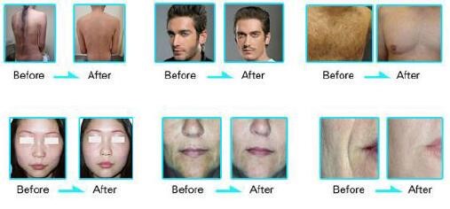 Oem Painless Opt Shr Ipl Machine Permanent Fast Hair Removal