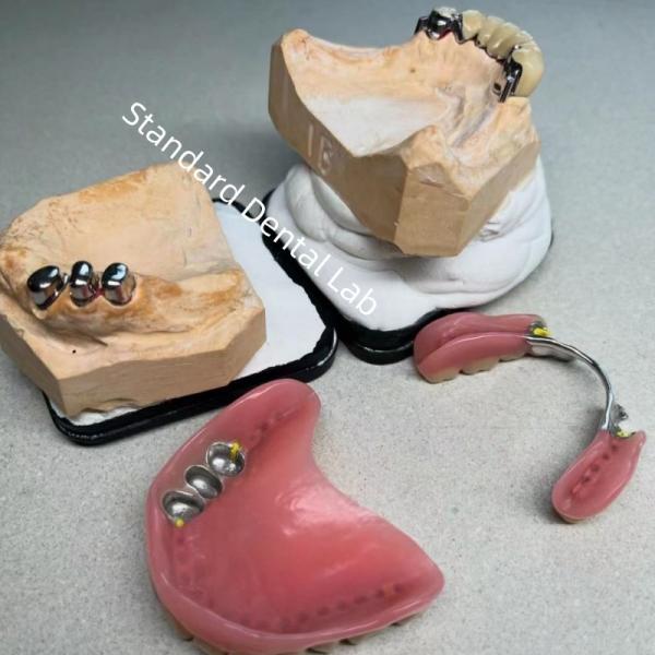 High Esthetics CAD CAM Tooth Partial Denture Attachment Replacement Standard