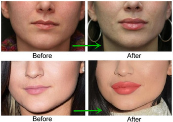 CE Certificate Hyaluronic Acid Cross Linked Dermal Filler For Fuller Lips