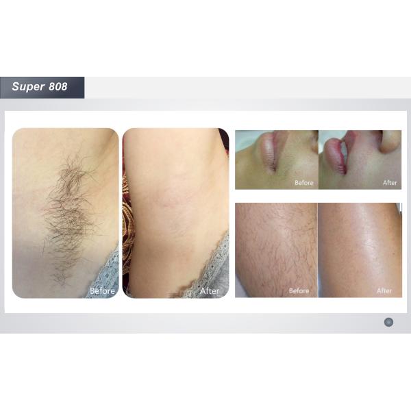 12.4 Inch 755nm 1064 Nm Laser Hair Removal Beauty Laser Machine