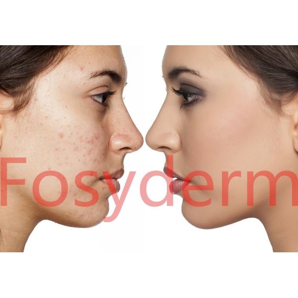 Injectable Cross Linked Hyaluronic Acid Dermal Fillers Skin Rejuvenation 2ml