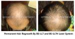 300 Watts Clinic Laser Treatment For Hair Loss , Low Level Laser Therapy Hair