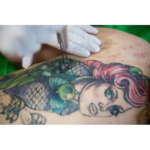best laser tattoo removal machine