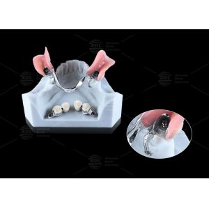 0.1mm Tolerance CEKA REVAX Attachment Titanium 3mm Vertical Clearance