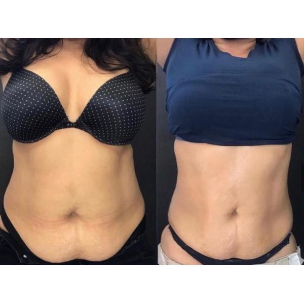 Non Touching Body Sculpting Machine