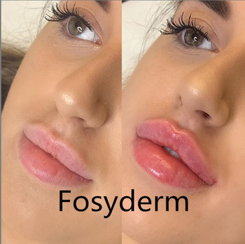 CE Certificate Hyaluronic Acid Cross Linked Dermal Filler For Fuller Lips