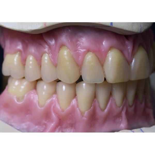 Buy Hot Cured Full Arch Removable Acrylic Full Denture at wholesale prices
