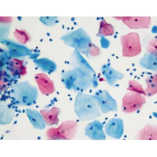 CE Certified TCT PAP Staining Reagent and Test Kit Cervical Cancer Screening