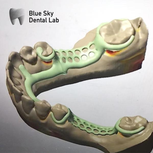Removable Partial Denture Metal Framework Partial Denture Framework Design